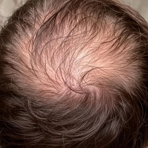 Weak & thinning hair